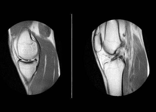 Fotografía de una resonancia de rodilla